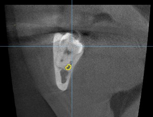 ７．親知らず２　CT２